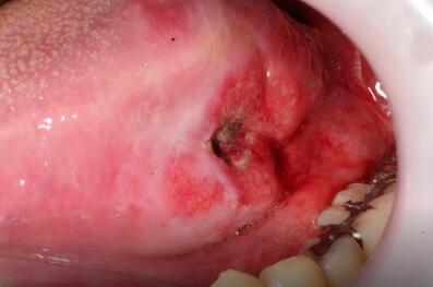 舌癌早期疼吗图片